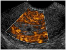 Ultrasound of the Pelvis1 Ultrasound of the Pelvis1